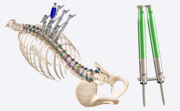 Spinal Fixation | Spartan Medical